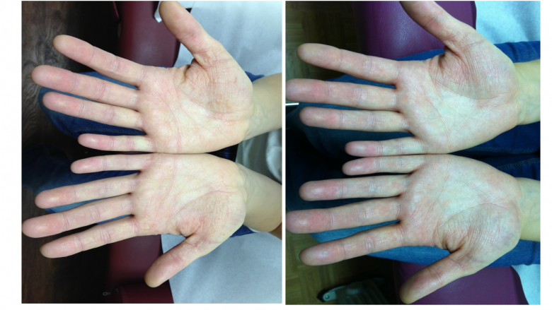 Ecsema (Atopic Dermatitis) Treated at St. Louis Acupuncture and Chinese Herbal Medicine