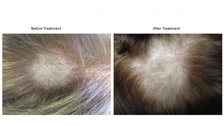 Hair Loss treated at St. Louis Acupuncture and Chinese Herbal Medicine